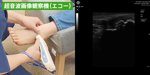 超音波画像観察機(エコー)